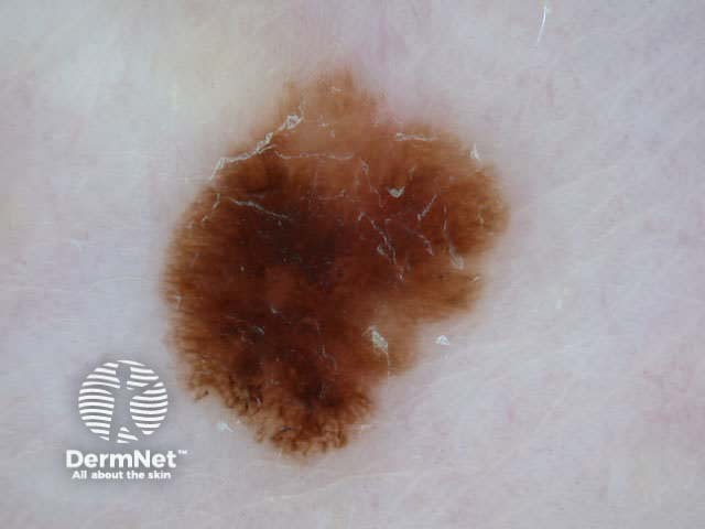 Melanoma in situ