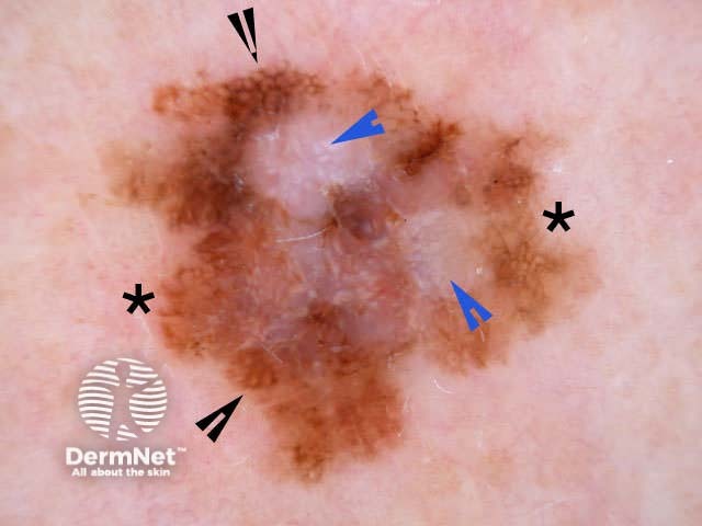 Melanoma