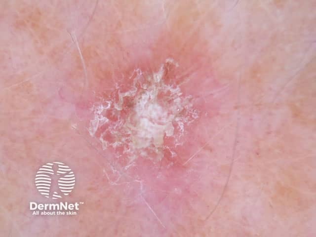 Dermoscopy of actinic keratosis