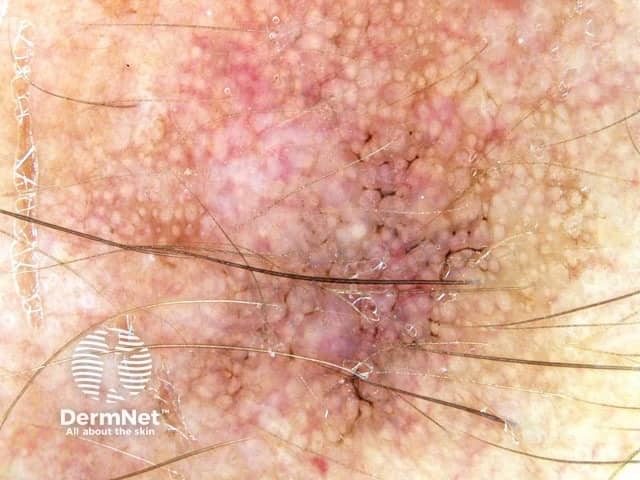 Dermoscopy of actinic keratosis