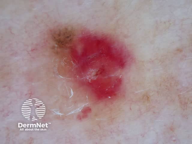 Amelanotic melanoma dermoscopy