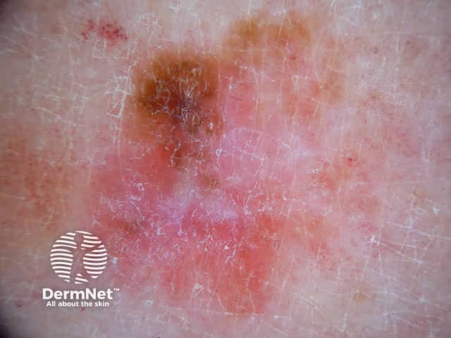 Amelanotic melanoma dermoscopy