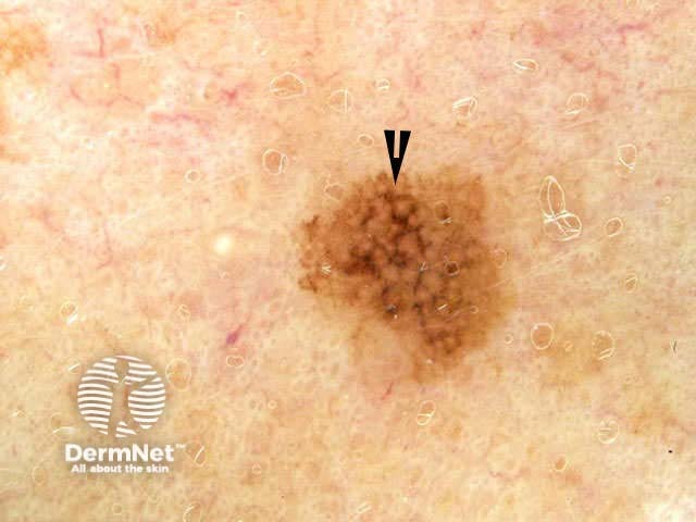 Atypical lentiginous hyperplasia