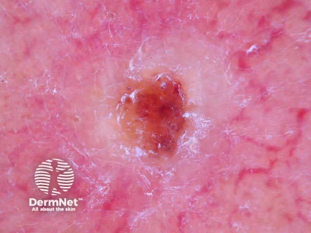 White nodule, telangiectasia