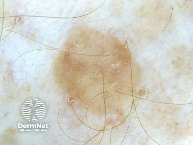 Seborrhoeic keratosis dermoscopy