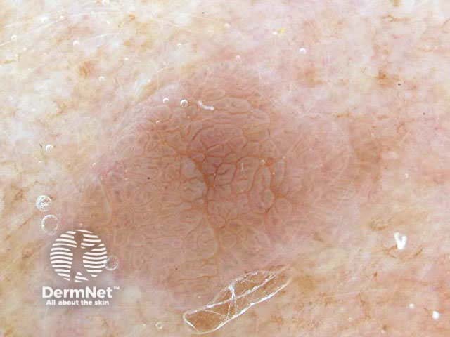 Seborrhoeic keratosis dermoscopy