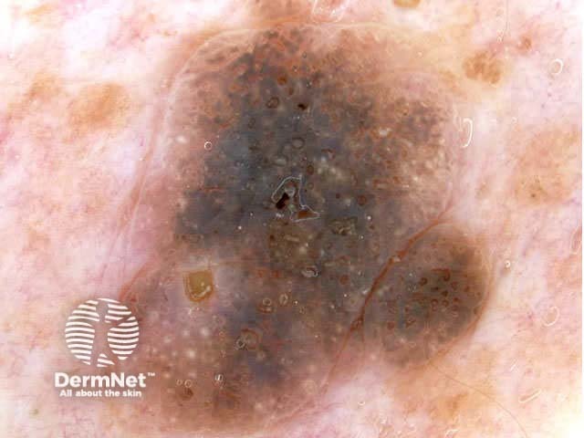 Seborrhoeic keratosis dermoscopy