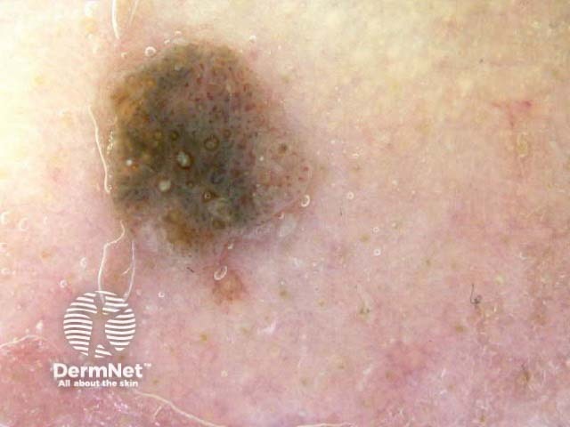 Seborrhoeic keratosis dermoscopy