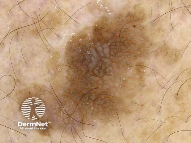 Seborrhoeic keratosis dermoscopy