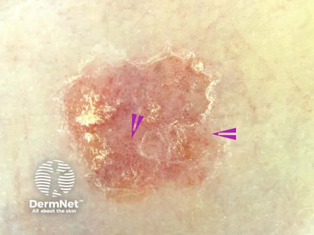 Bowen's disease