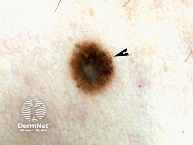 Melanoma