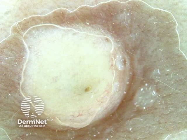 Large epidermal cyst