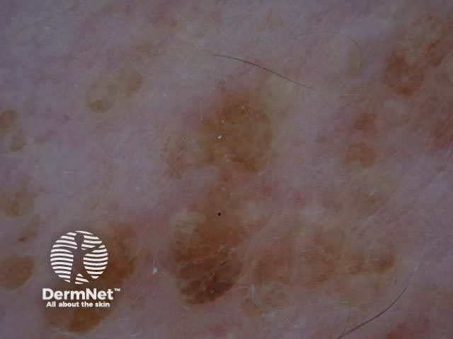 Epidermal naevus