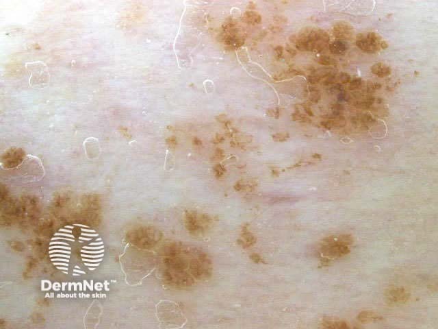 Epidermal naevus