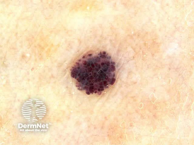 Cherry angioma