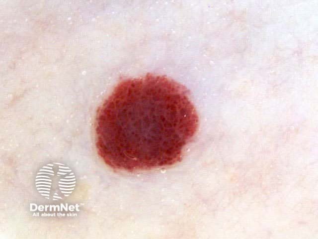 Cherry angioma