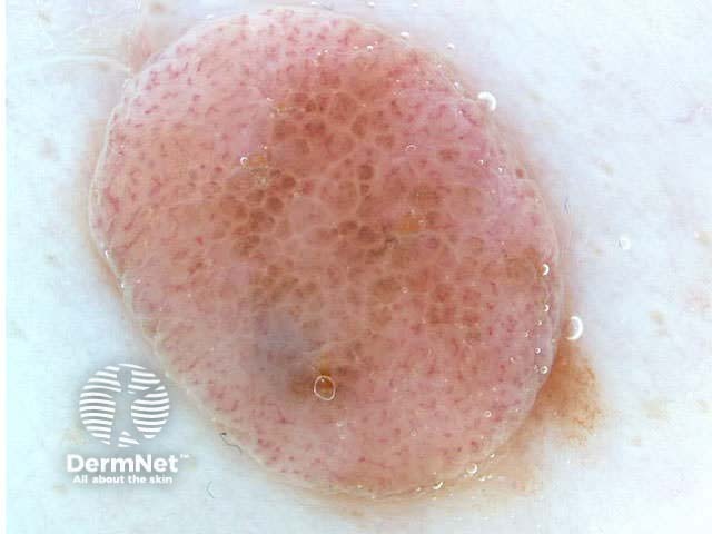 Melanocytic naevus