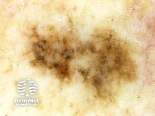 Lentiginous melanoma