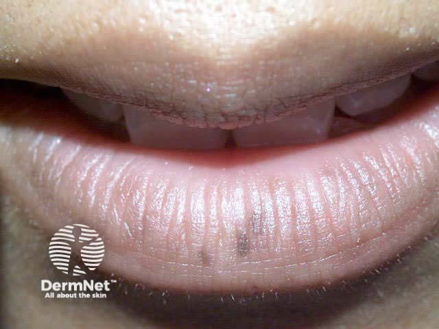 Mucosal melanosis