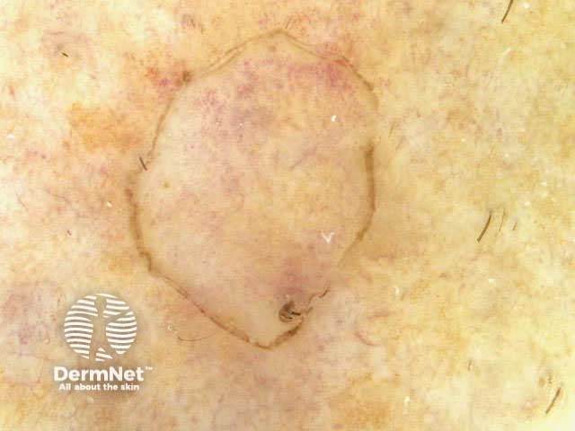 Porokeratosis