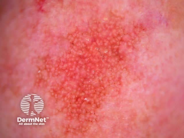 Actinic keratosis