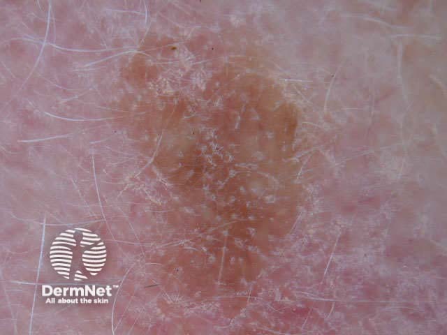 Seborrhoeic keratosis