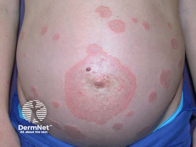 Pemphigoid gestationis