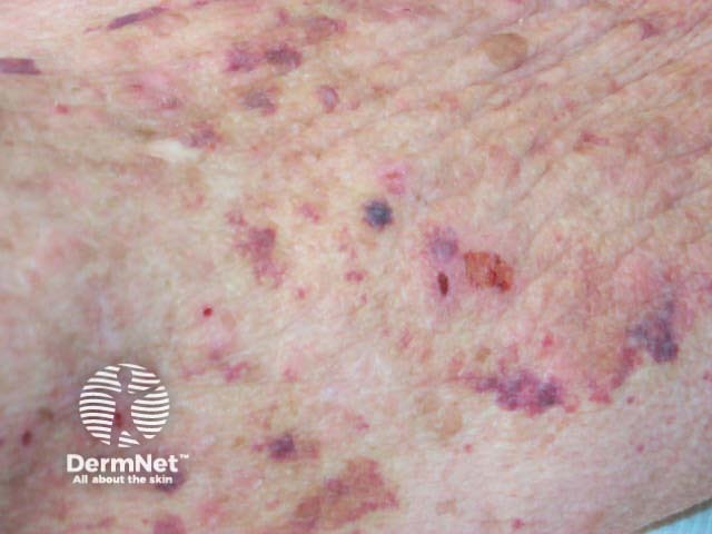 bullous pemphigoid