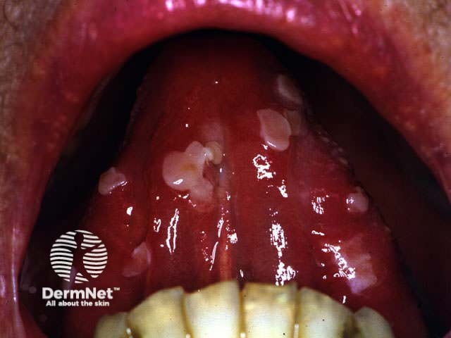 Oral pemphigus