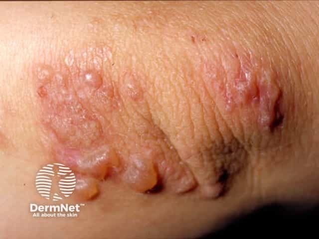 Dermatitis herpetiformis