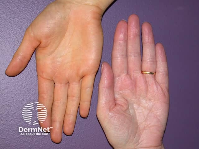 Orange pigmentation on the palm due to betacarotene medication