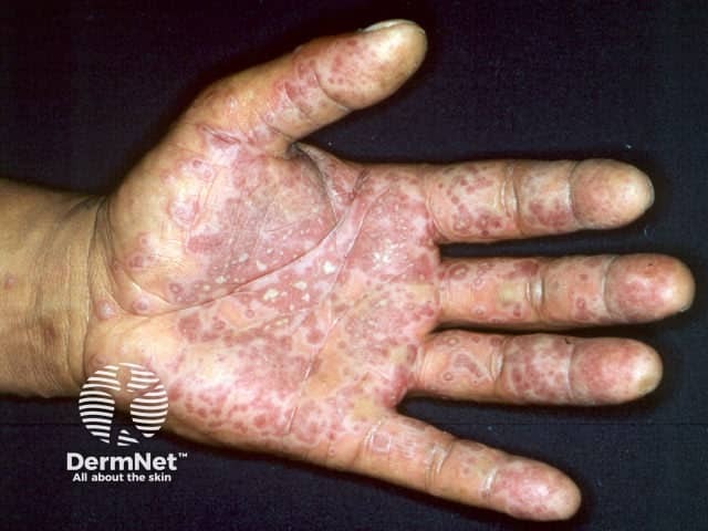 Erythema multiforme minor