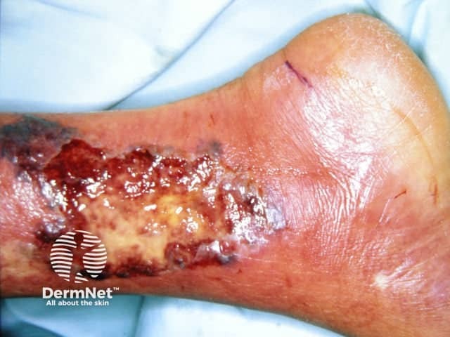 Pyoderma gangrenosum