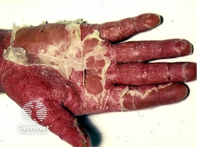 Erythrodermic psoriasis