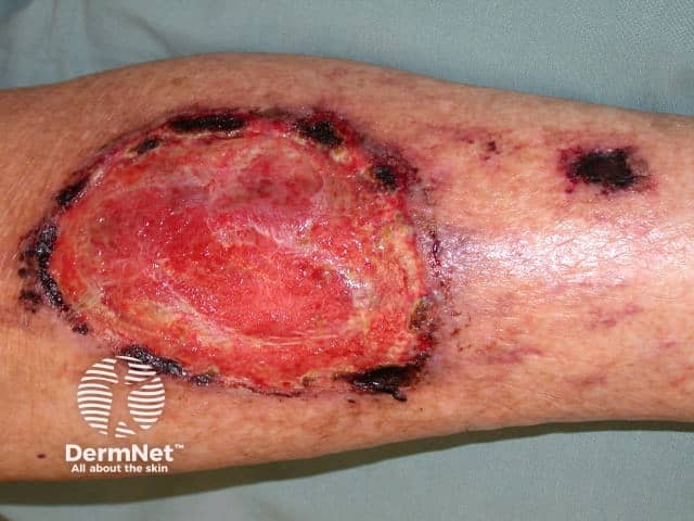 Pyoderma gangrenosum