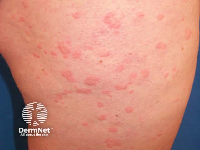 Chronic urticaria