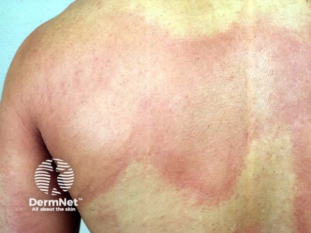 Urticaria