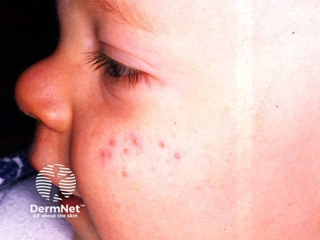 Infantile acne