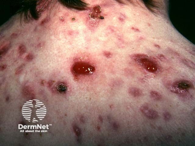 Granulomas and crusted acne lesions