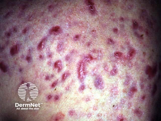 Hypertrophic scarring following acne fulminans