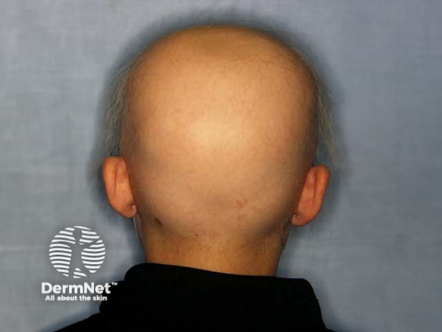 Alopecia universalis