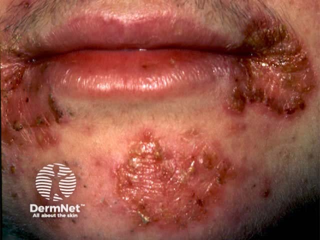 Impetigo