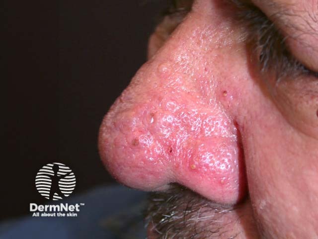 Inflammatory rosacea