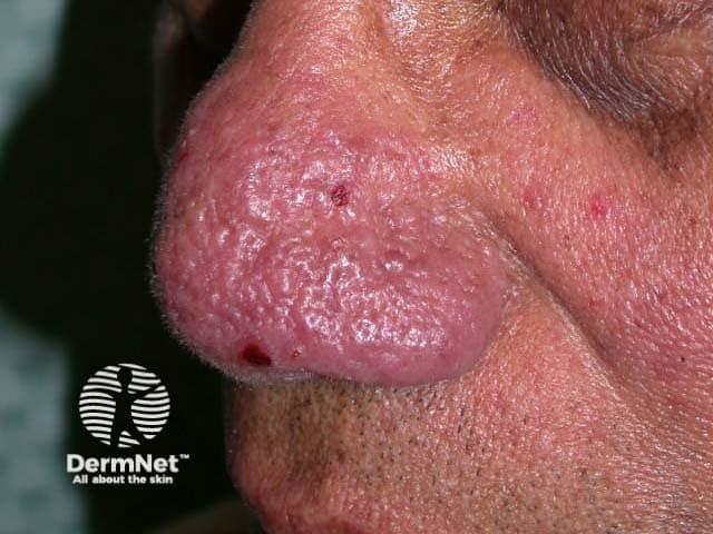 Rhinophyma