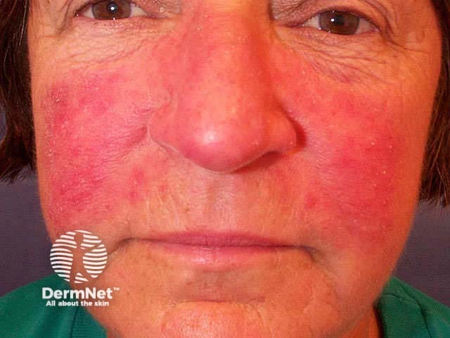 Inflamed rosacea resulting in sensitive skin