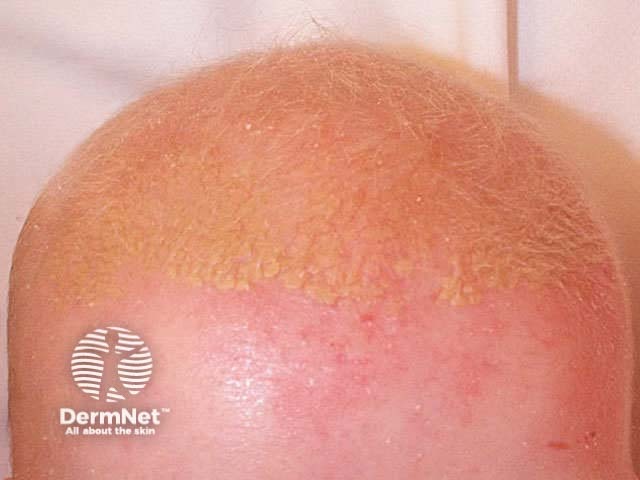 Infantile seborrhoeic dermatitis