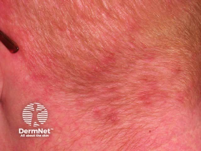 Scalp folliculitis