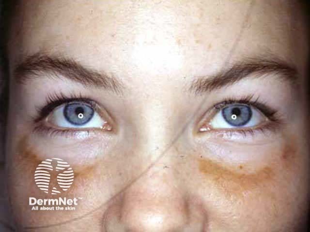 Irritant dermatitis due to benzoyl peroxide