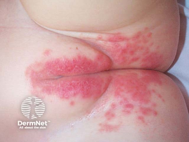 Napkin dermatitis: candidiasis