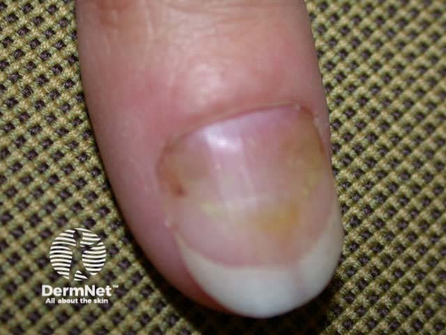 Proximal onchomycosis